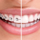 Teeth Braces